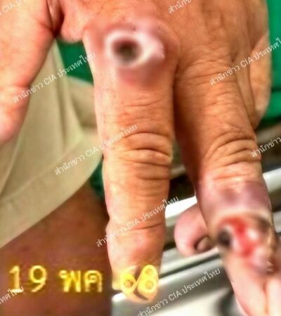 มุกดาหาร​ -​ด่วน! พบผู้ป่วย “แอนแทรกซ์” รายที่ 5 ในมุกดาหาร ชำแหละหมูก่อนเดินทางไปทำไร่อ้อยใน สปป.ลาว เกิดแผลติดเชื้อลุกลามก่อนกลับมารักษาในไทย ‼️